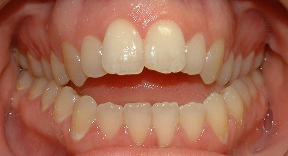 Можно ли делать протезирование зубов при неправильном прикусе